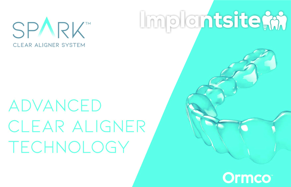 Clínica Dental Implantsite revoluciona la ortodoncia invisible con Spark